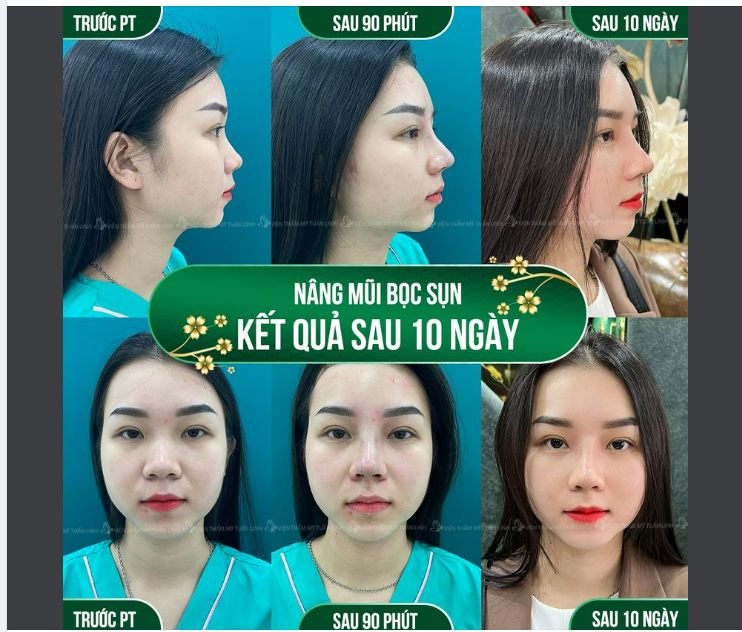 Cận cảnh chiếc mũi bọc sụn sau 10 ngày tái khám tại Tuấn Linh 