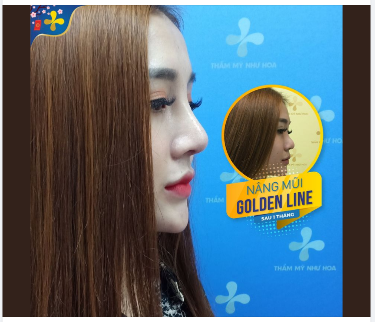 Góc nghiêng đẹp miễn chê sau khi nâng mũi Golden Line - Dr.Tống Hải.