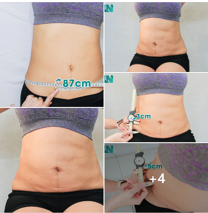 CHỊ KH VIỆT KIỀU MỸ TỪNG HÚT MỠ TẠI CƠ SỞ KHÔNG CHUYÊN SÂU KHIẾN BỤNG LỒI LÕM, NGẤN MỠ DÀY
