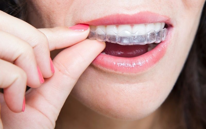 Niềng răng Invisalign mang lại hiệu quả thẩm mỹ cao