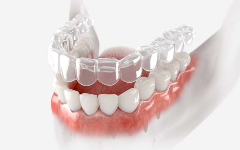 Miếng đệm răng giúp giảm đau khi chỉnh nha