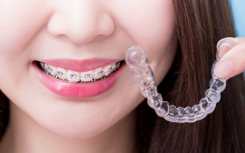 Niềng răng Invisalign có tốt không? Địa chỉ niềng răng Invisalign uy tín