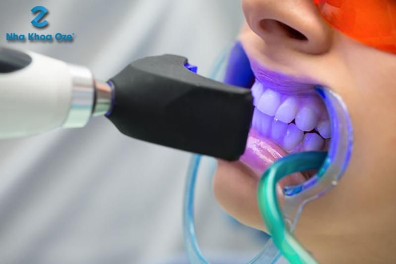 Review dịch vụ tẩy trắng răng tại nha khoa Oze có tốt không hay dính phốt lừa đảo?