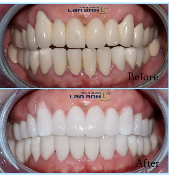 Hình ảnh 1 ca phục hình toàn hàm do Bác sĩ Lân- chi nhánh 288/1 Huỳnh Văn Bánh thực hiện.