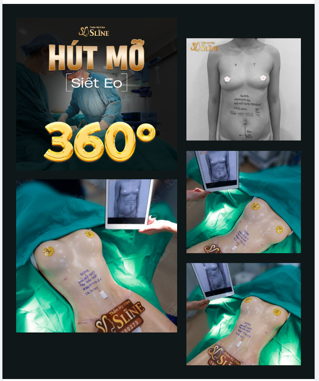 "TÁI SINH BODY" với COMBO HÚT MỠ 360° +NÂNG NGỰC NANOCHIPEG.