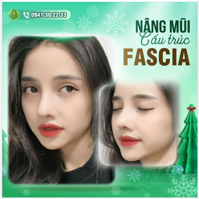 NÂNG MŨI CẤU TRÚC FASCIA TRỢ GIÁ KHỦNG