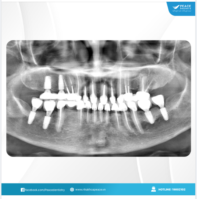 Tái khám implant sau 7 năm ăn nhai thoải mái và dự báo quen thuộc: hoàn toàn có thể sử dụng ổn định trọn đời.