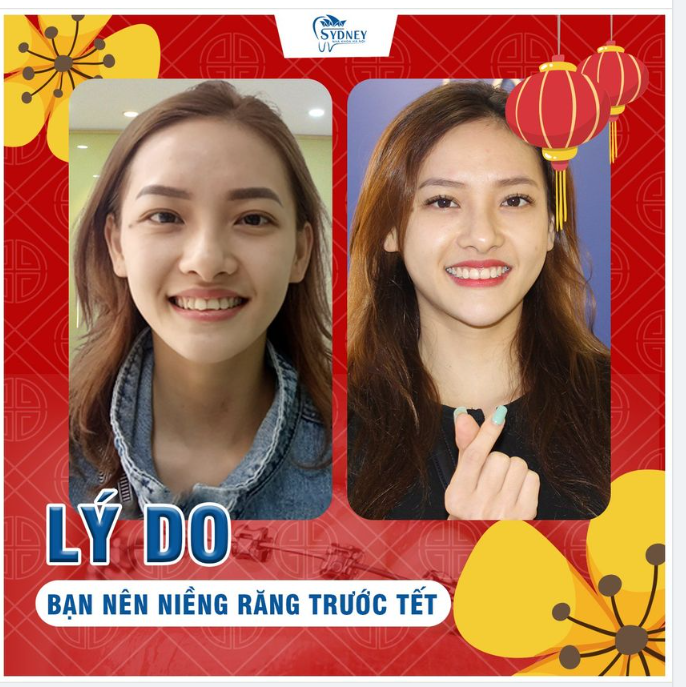 Lý do bạn nên niềng răng trước Tết Nguyên đán