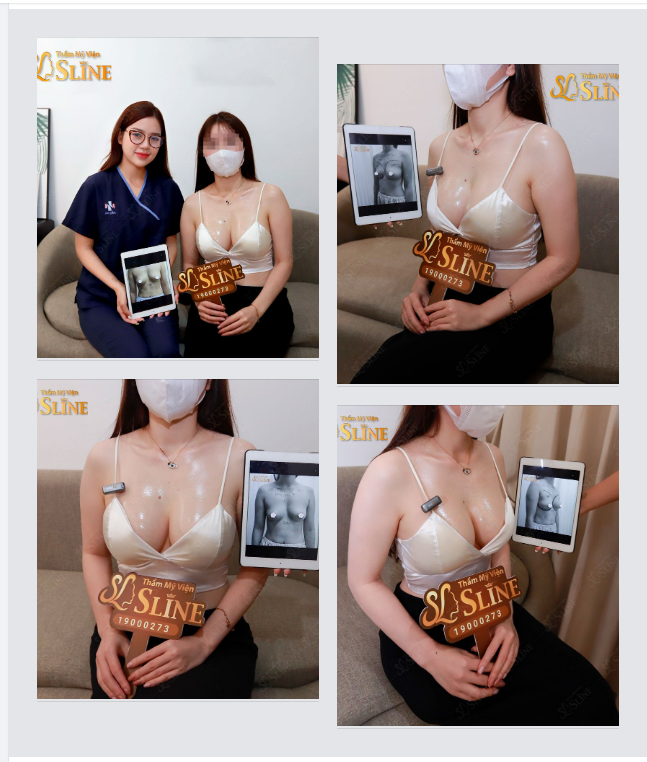 Nâng ngực sau 5 NĂM ngực còn đẹp không ?