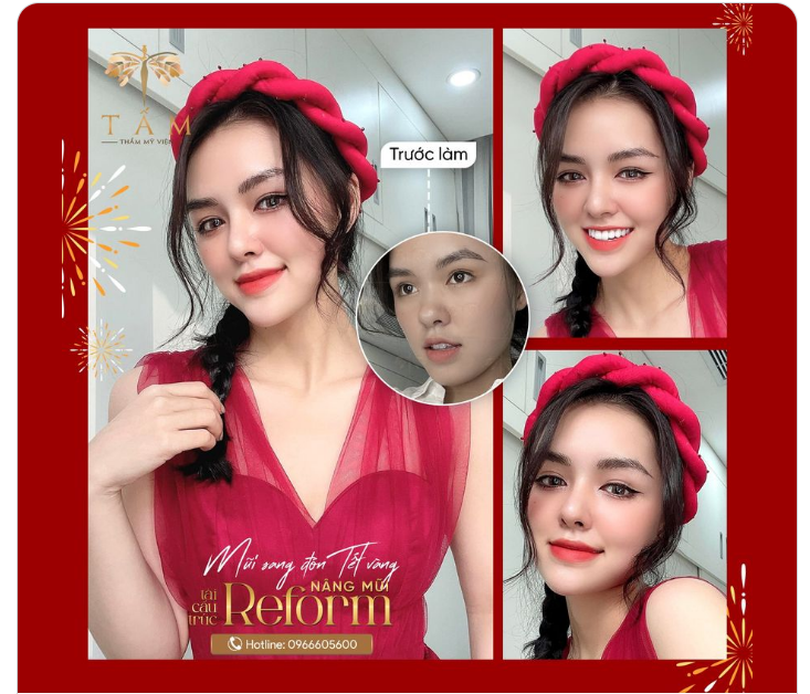 “Nâng mũi xong sang cả khuôn mặt, mình thấy quá đúng đắn”