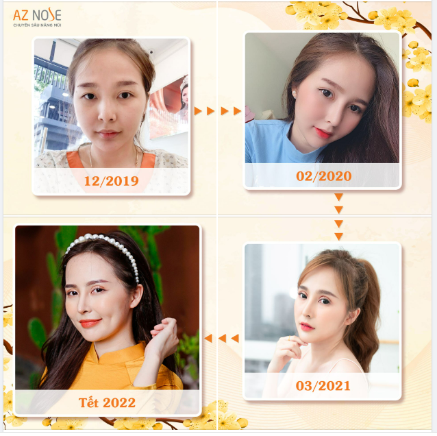 Vẫn là gương mặt ấy, nhưng Tết này đã có mũi xinh, lung linh hơn rất nhiều!!