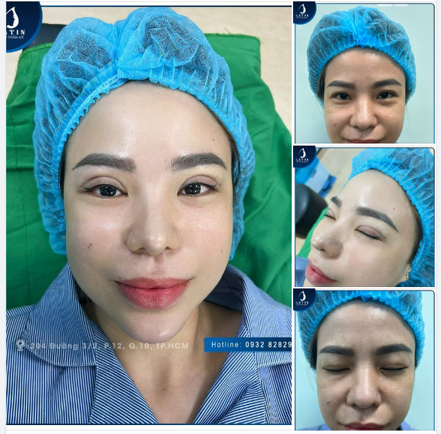 Biến hình "mí xinh" chỉ trong vòng chưa đến 1 tiếng đồng hồ