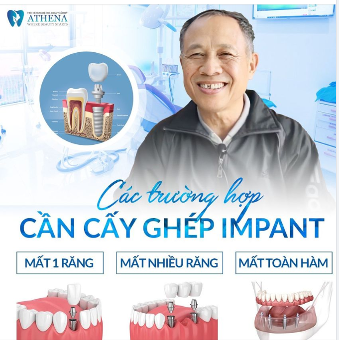 CÁC TRƯỜNG HỢP NÊN CẤY GHÉP IMPLANT