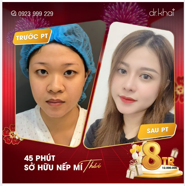 MÍ ĐẸP MŨI XINH - TỰ TIN ĐÓN TẾT