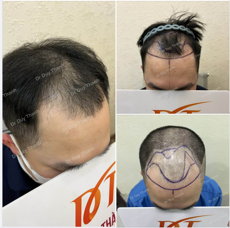 CHUẨN BỊ CẤY 1800 NANG TÓC BOY THANH HÓA 30 TUỔI