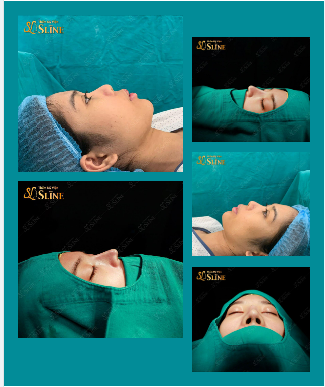 Đừng vì độ hot của những ca đại phẫu trong ngày, mà tạm quên đi những ca. NÂNG MŨI CẤUTRÚCSOFXIL của Sline , bởi vì sau đây bạn sẽ phải thốt lên ‘’WOW” đó.