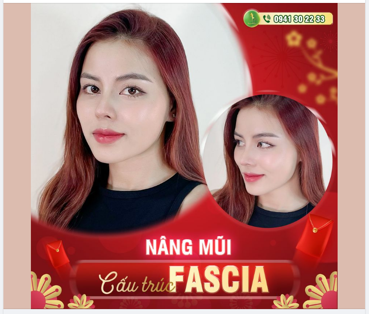 MŨI ĐẸP KỊP TẾT - THỜI ĐIỂM VÀNG NÂNG MŨI