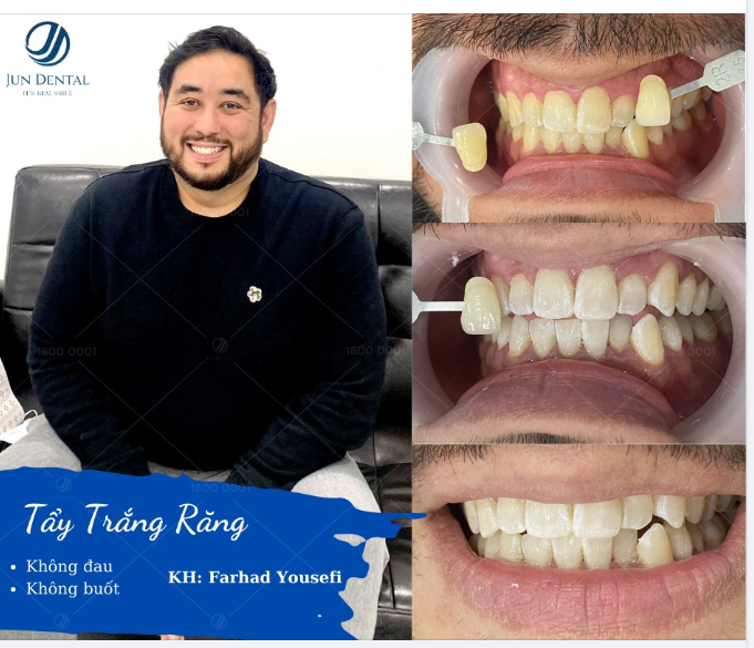 ƯU ĐÃI ĐÓN TẾT - RĂNG TRẮNG TỰ TIN TỎA NẮNG