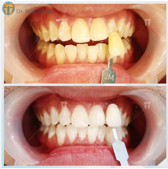 RĂNG TRẮNG SÁNG - NỤ CƯỜI TƯƠI XINH