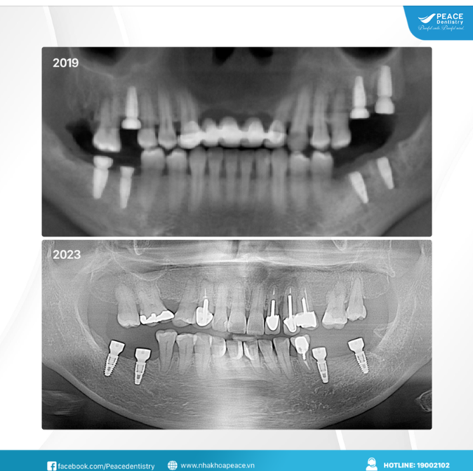 "Cấy trụ Implant rồi nhưng sau vài năm mới cố định răng sứ thì có ảnh hưởng gì không?"