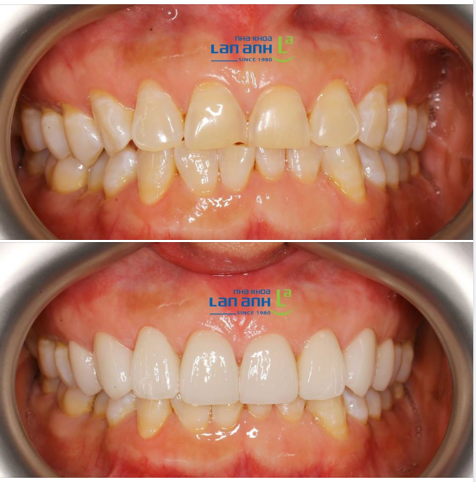 Một trường hợp làm Veneer sứ tại nha khoa Lan Anh 61 Nguyễn Cơ Thạch, bác sĩ Quý Liên thực hiện