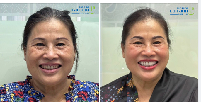 Một ca phục hình răng sứ màu trắng tự nhiên tại chi nhánh 292 Huỳnh Văn Bánh, Phú Nhuận