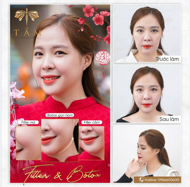BOTOX THON GỌN HÀM và FILLER MÁ, CẰM SẼ THAY ĐỔI BẠN NHƯ THẾ NÀO????