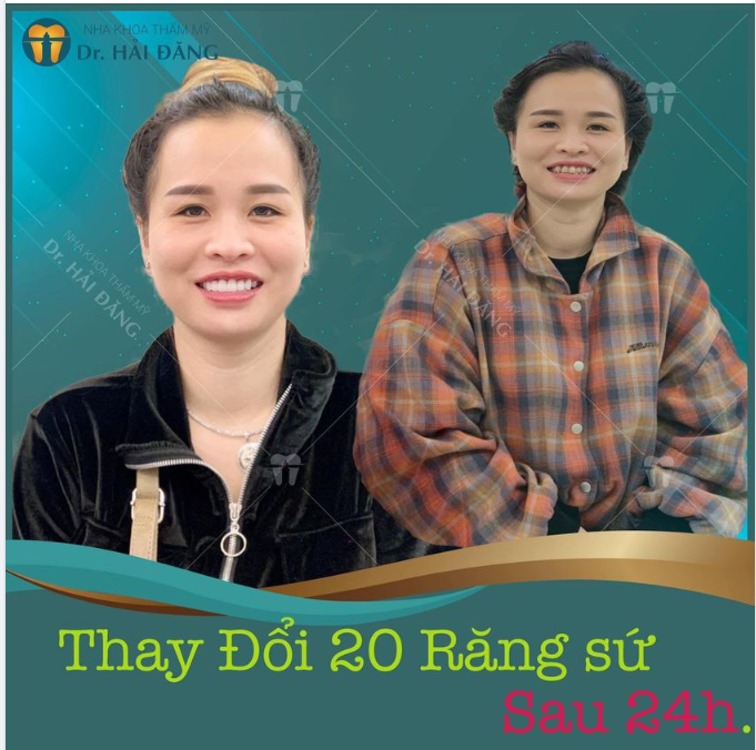 LÀM ĐẸP RĂNG SỨ THẨM MỸ CHỈ 24H CÓ RĂNG SỨ ĐẸP ĐÓN TẾT