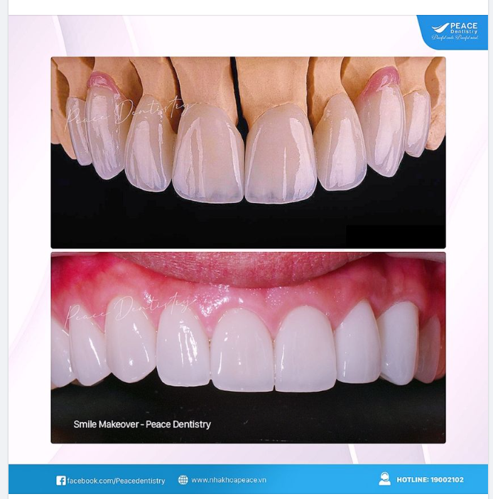  Bác sĩ giỏi,  vật liệu sứ tốt và công nghệ hiện đại không chỉ là sự đảm bảo về hiệu quả thẩm mỹ cao, an toàn,