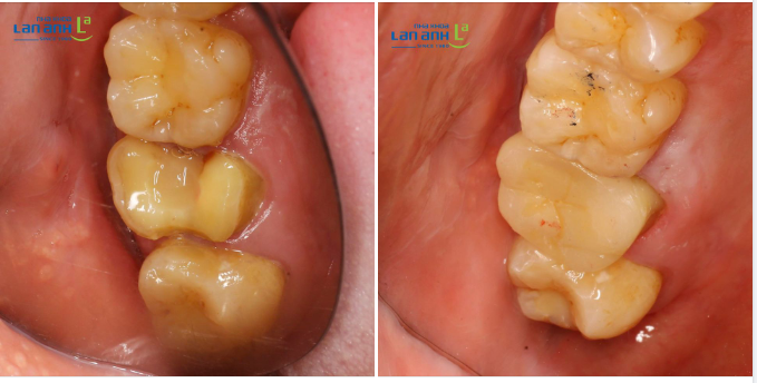 Một trường hợp phục hồi răng bị bể vỡ lớn bằng Onlay sứ của bác sĩ Quý Liên, chi nhánh 61 Nguyễn Cơ Thạch, Q2