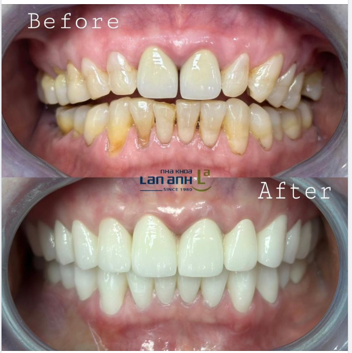 Một ca phục hình răng sứ tại chi nhánh 292 Huỳnh Văn Bánh, Phú Nhuận