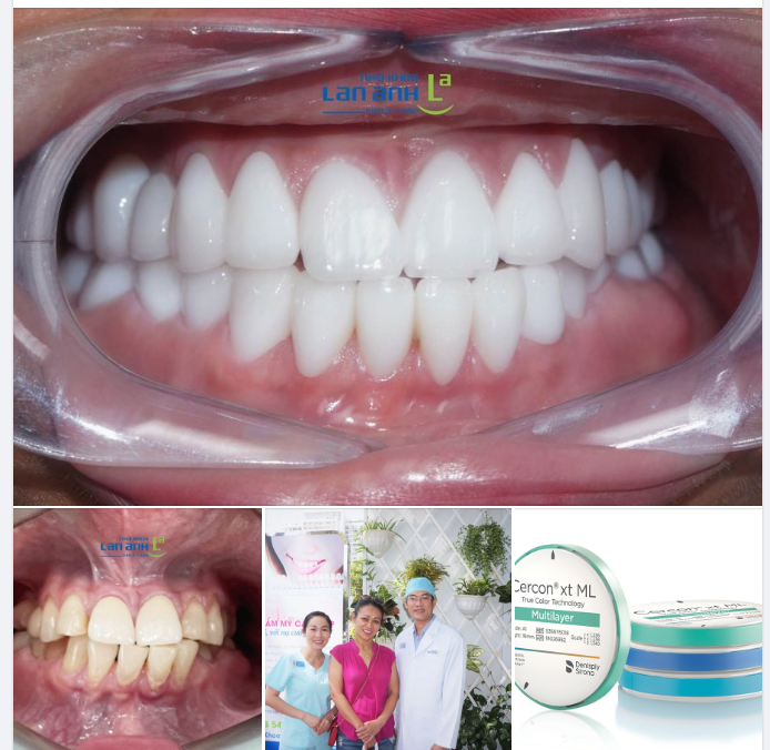 Răng sứ Cercon là thương hiệu răng sứ nổi tiếng từ rất lâu của tập đoàn Densply Sirona - Đức.