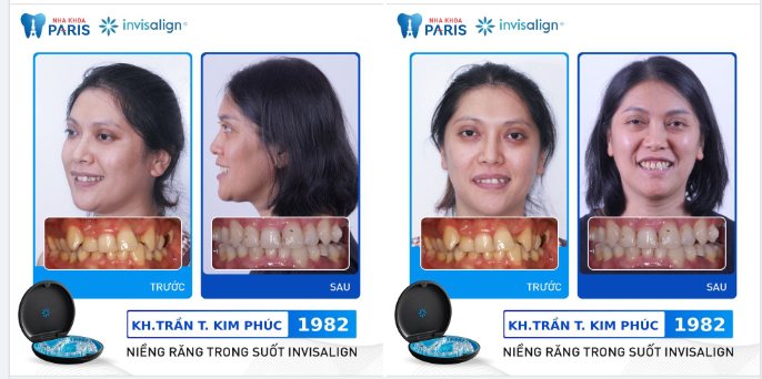 Khách hàng Kim Phúc (sn 1982, Thủ Đức) gặp tình trạng răng mọc chen chúc khá nhiều gây mất thẩm mỹ.