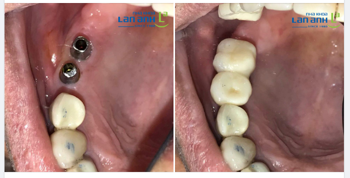 Một ca đặt Implant phục hình răng mất của bác sĩ Thuỷ, chi nhánh 292 Huỳnh Văn Bánh, Phú Nhuận