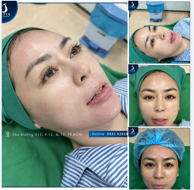 Độn cằm sụn Mỹ V-line siêu đẹp cho khách hàng