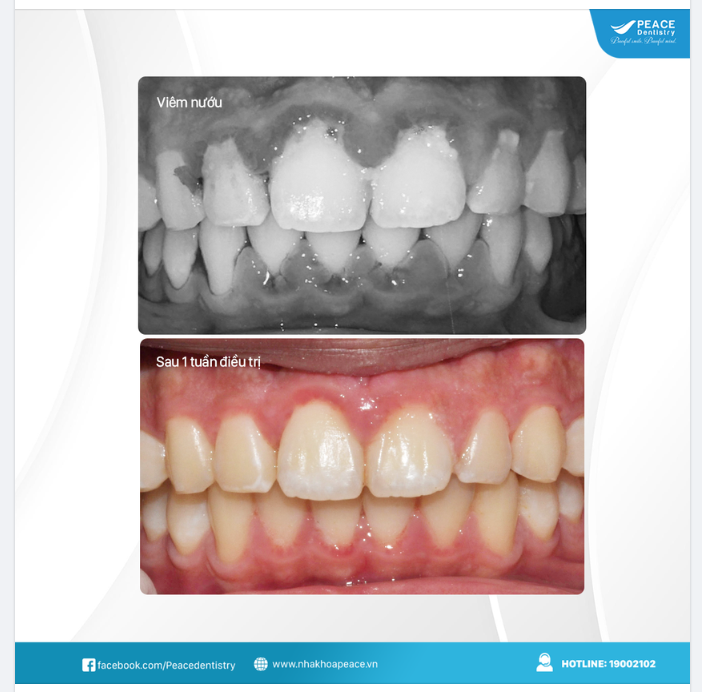  Viêm nướu nếu điều trị kịp thời, đúng cách thì khá đơn giản, không tốn kém với hiệu quả cao.