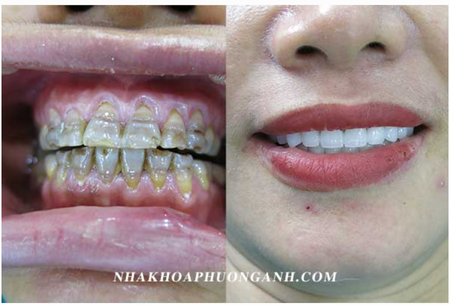 Bọc răng sứ thẩm mỹ là gì? có tốt không? có đau không?