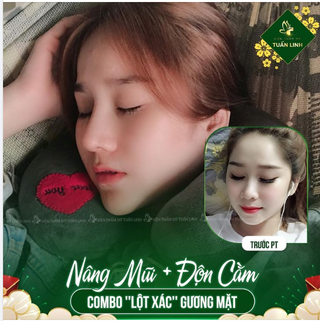 COMBO Nâng mũi + Độn cằm sẽ không làm bạn thất vọng.