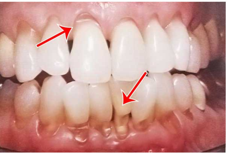 Răng mòn do chải răng không đúng cách