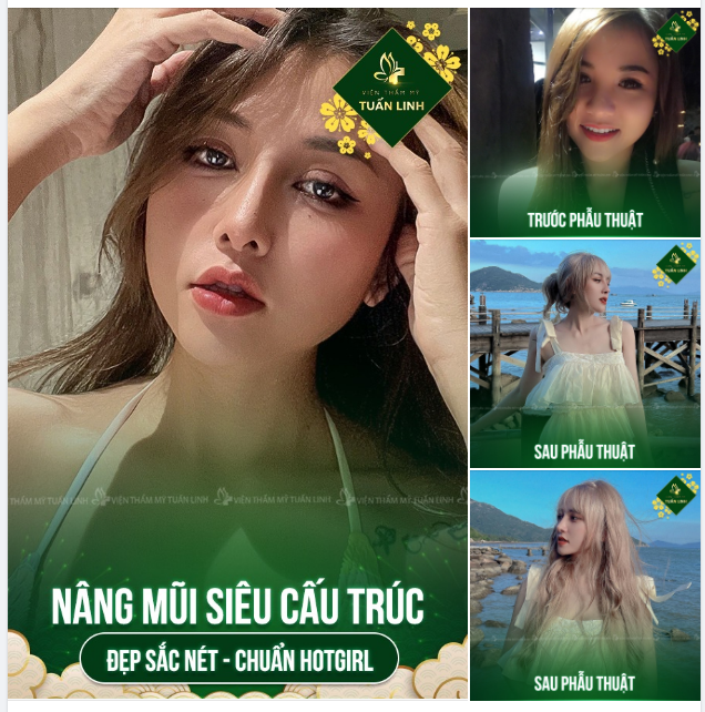 Sở hữu ngay dáng mũi đẹp chuẩn Hotgirl bằng phương pháp nâng mũi siêu cấu trúc 