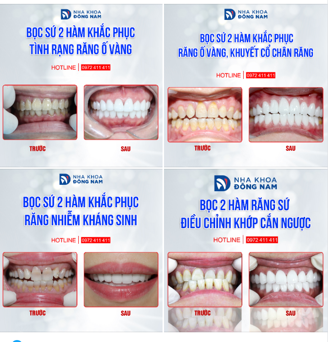 TỔNG HỢP 1 VÀI CASE BỌC RĂNG TOÀN SỨ HI-ZIRCONIA XUẤT SẮC NHẤT NĂM