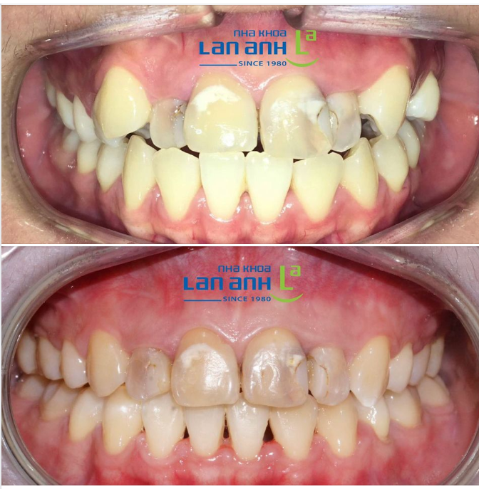 Một ca niềng tại chi nhánh Phú Nhuận, bác sĩ Huyền điều trị