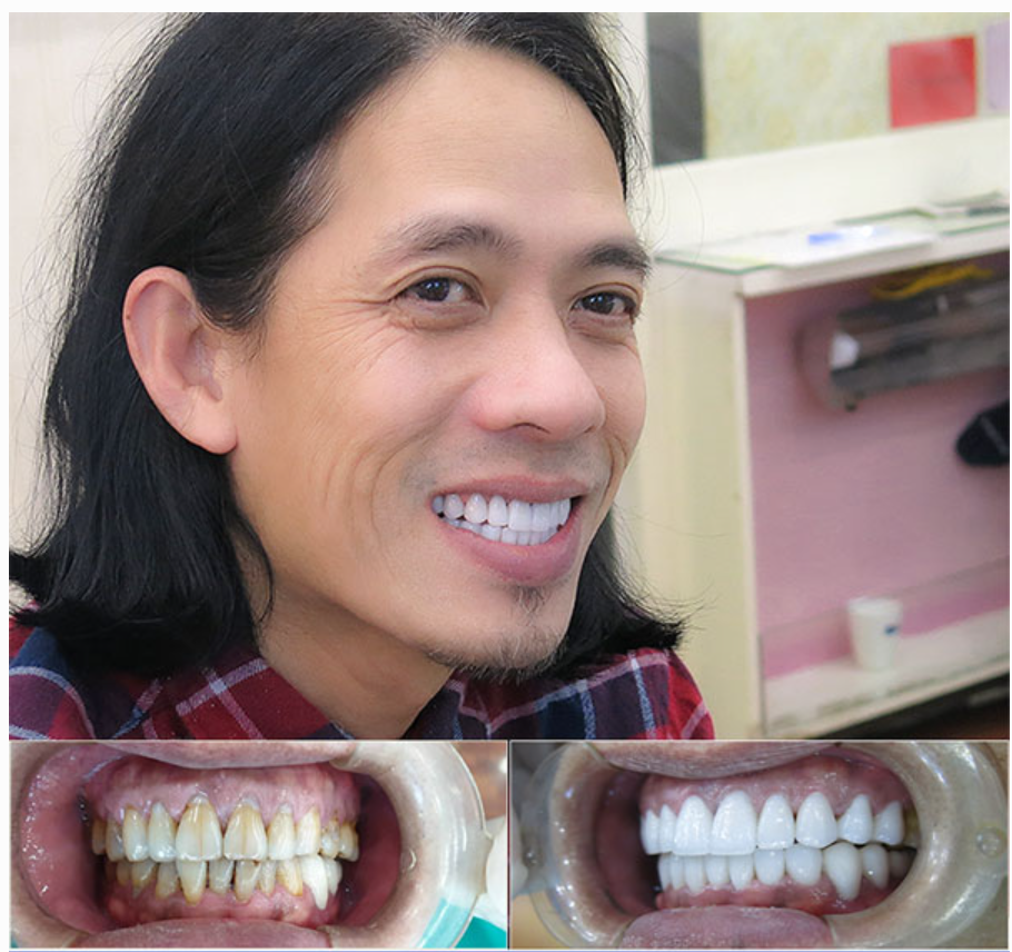 Bọc răng sứ có đau không?