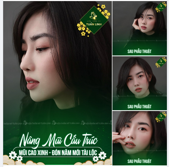 NÂNG MŨI CẤU TRÚC - MŨI CAO XINH ĐÓN NĂM MỚI TÀI LỘC!