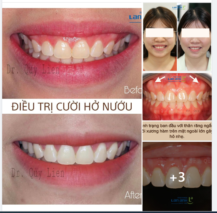 Trường hợp dưới đây là ca cắt nướu làm dài thân răng của Bác sĩ Quý Liên tại Nha khoa Lan Anh chi nhánh Sala, quận 2.