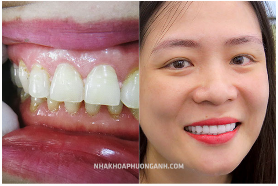 Vì Sao Viền Nướu Bị Đen Sau Khi Bọc Răng Sứ?