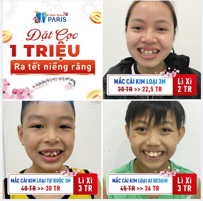 Bố mẹ ơi, niềng răng cho con giá siêu hời này!