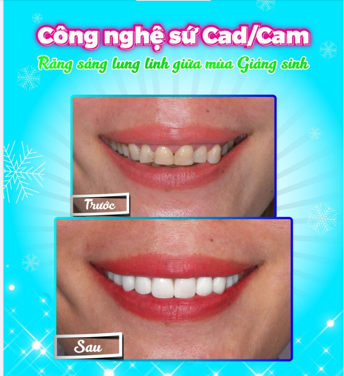 Công nghệ sứ Cad/Cam - Răng sáng lung linh giữa mùa Giáng sinh