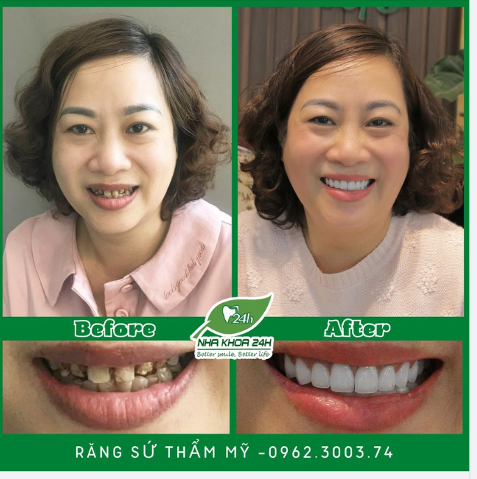 SỰ THAY ĐỔI KỲ DIỆU VỚI DỊCH VỤ RĂNG SỨ THẨM MỸ