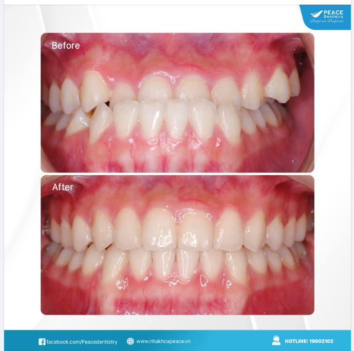 Niềng răng chỉnh móm, hoàn thành sau 21 tháng
